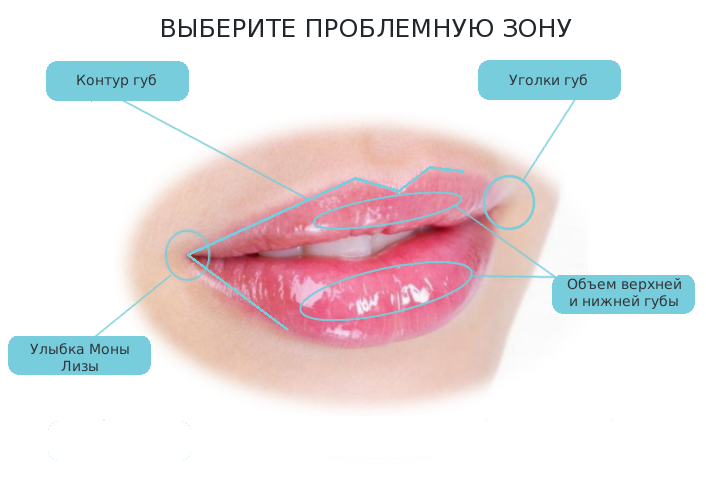 Хейлопластика(увеличение губ) методом V-Y, (одна губа)/корнер-лифт