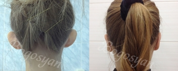 Отопластика