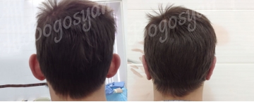 Отопластика