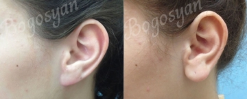 Отопластика