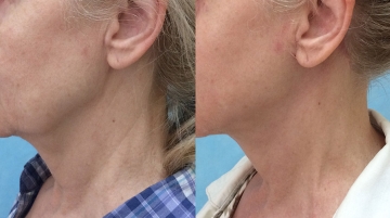 Пластика шеи (платизмопластика)