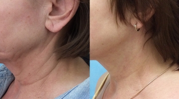 Пластика шеи (платизмопластика)