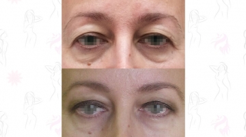 Подтяжка лба и бровей (фронто-темпоральный лифтинг)