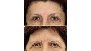 Подтяжка лба и бровей (фронто-темпоральный лифтинг)