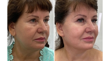 Подтяжка лба и бровей (фронто-темпоральный лифтинг)