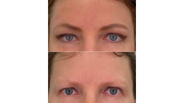 Подтяжка лба и бровей (фронто-темпоральный лифтинг)