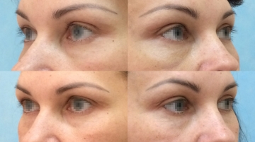 Подтяжка лба и бровей (фронто-темпоральный лифтинг)
