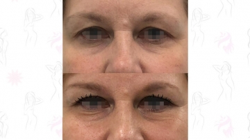 Подтяжка лба и бровей (фронто-темпоральный лифтинг)