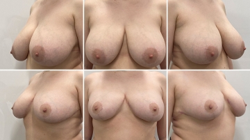 Уменьшение груди (редукционная маммопластика)