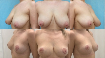 Уменьшение груди (редукционная маммопластика)