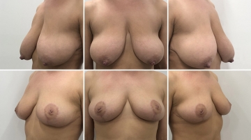 Уменьшение груди (редукционная маммопластика)