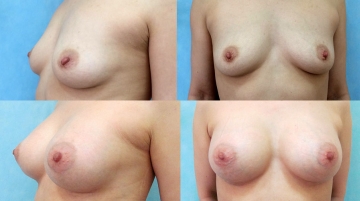 Увеличение грудных желез (маммопластика)