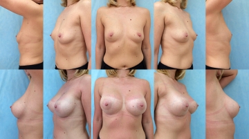 Увеличение грудных желез (маммопластика)