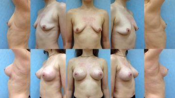 Увеличение грудных желез (маммопластика)