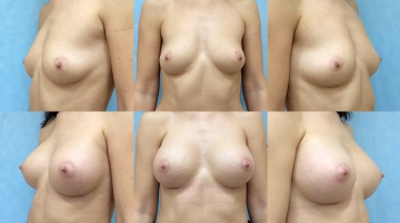 Увеличение грудных желез (маммопластика)