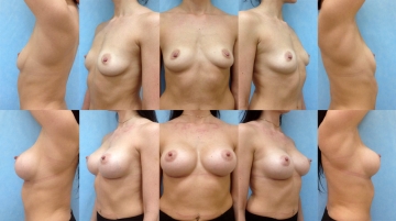 Увеличение грудных желез (маммопластика)