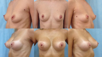 Увеличение грудных желез (маммопластика)
