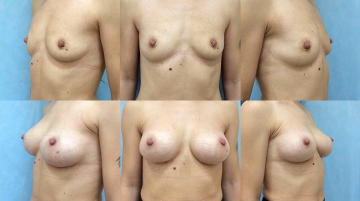Увеличение грудных желез (маммопластика)