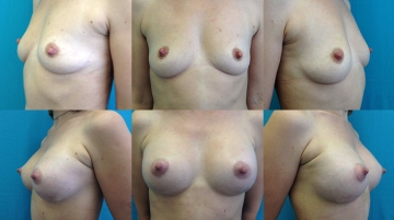 Увеличение грудных желез (маммопластика)