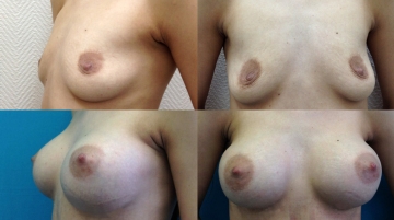 Увеличение грудных желез (маммопластика)