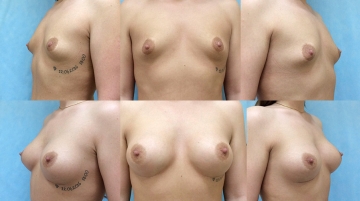 Увеличение грудных желез (маммопластика)