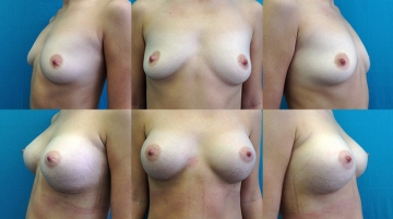 Увеличение грудных желез (маммопластика)