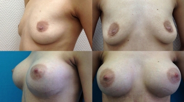 Увеличение грудных желез (маммопластика)