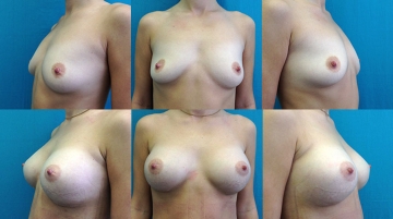 Увеличение грудных желез (маммопластика)