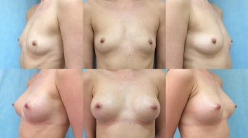 Увеличение грудных желез (маммопластика)