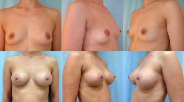 Увеличение грудных желез (маммопластика)