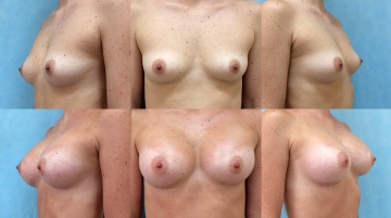 Увеличение грудных желез (маммопластика)
