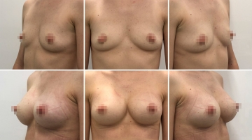 Увеличение грудных желез (маммопластика)