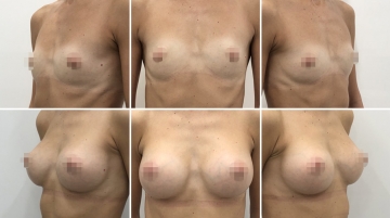 Увеличение грудных желез (маммопластика)