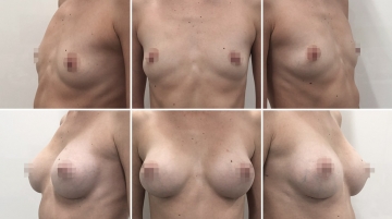 Увеличение грудных желез (маммопластика)