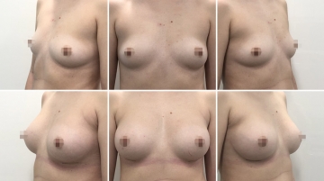 Увеличение грудных желез (маммопластика)