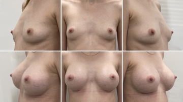 Увеличение грудных желез (маммопластика)