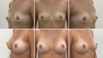Увеличение грудных желез (маммопластика)