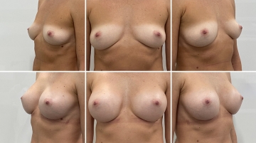 Увеличение грудных желез (маммопластика)