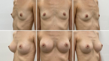 Увеличение грудных желез (маммопластика)