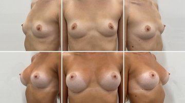 Увеличение грудных желез (маммопластика)