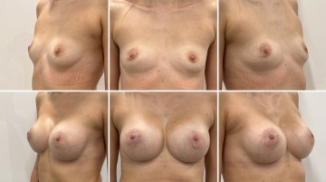Увеличение грудных желез (маммопластика)