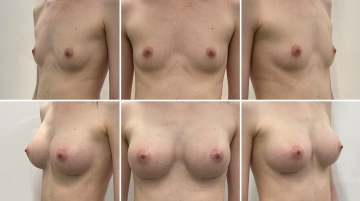 Увеличение грудных желез (маммопластика)