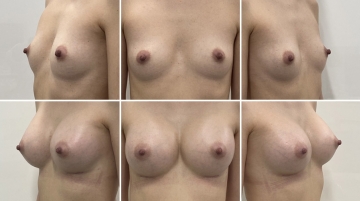 Увеличение грудных желез (маммопластика)