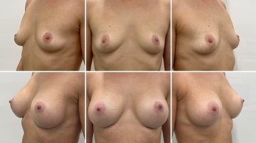 Увеличение грудных желез (маммопластика)