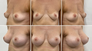Увеличение грудных желез (маммопластика)