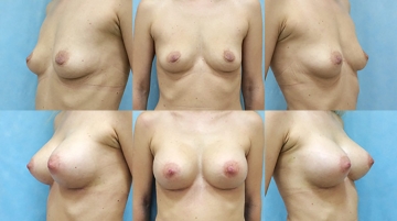 Увеличение грудных желез (маммопластика)