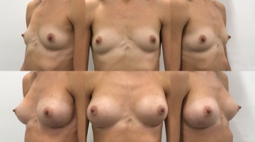 Увеличение грудных желез (маммопластика)