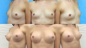 Увеличение грудных желез (маммопластика)