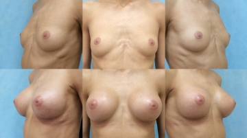 Увеличение грудных желез (маммопластика)