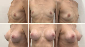 Увеличение грудных желез (маммопластика)